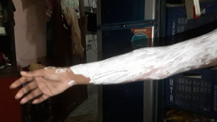 irani-sample-burning-hand-fire
